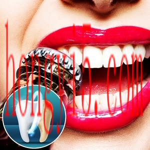 十大金属牙齿排行榜(陶瓷牙齿十大名牌排行榜)插图1